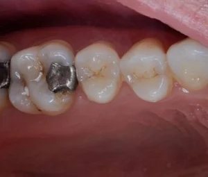 amalgam dolgular